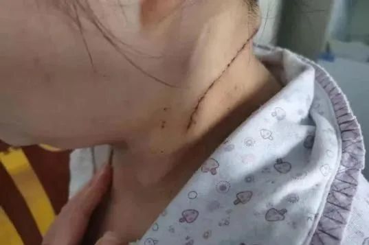 卸下包袱长达二十年的巨大颈部肿瘤终于被切掉